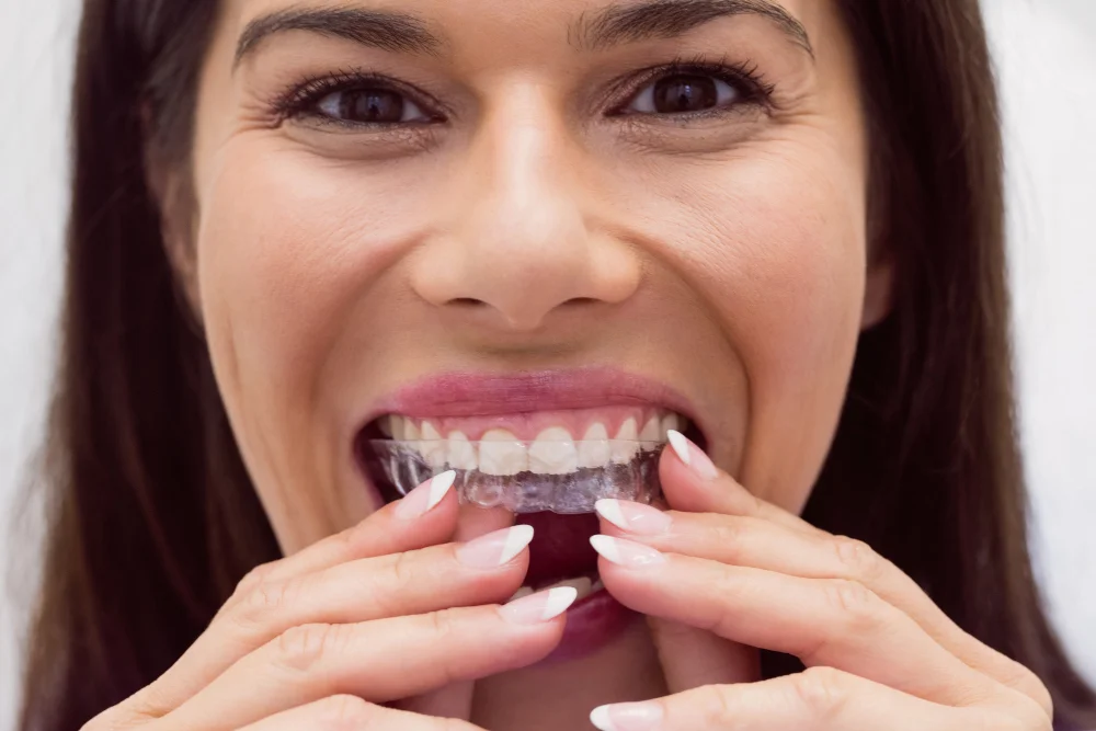 Aparat Invisalign u kobiety