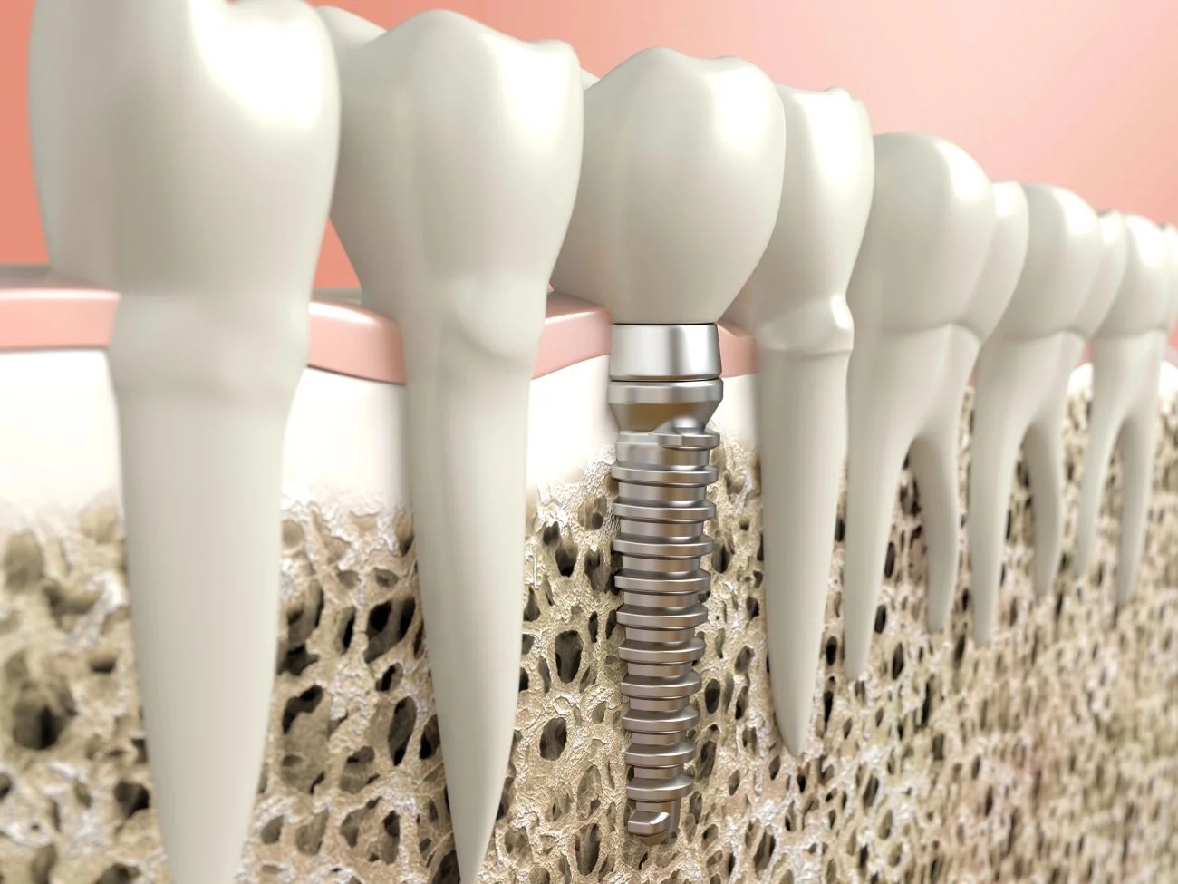 Jak wygląda proces wszczepienia implantu krok po kroku? Etapy i zalecenia